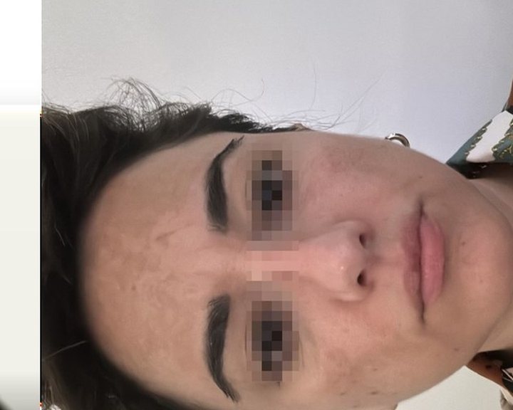 לפני טיפול באקנה